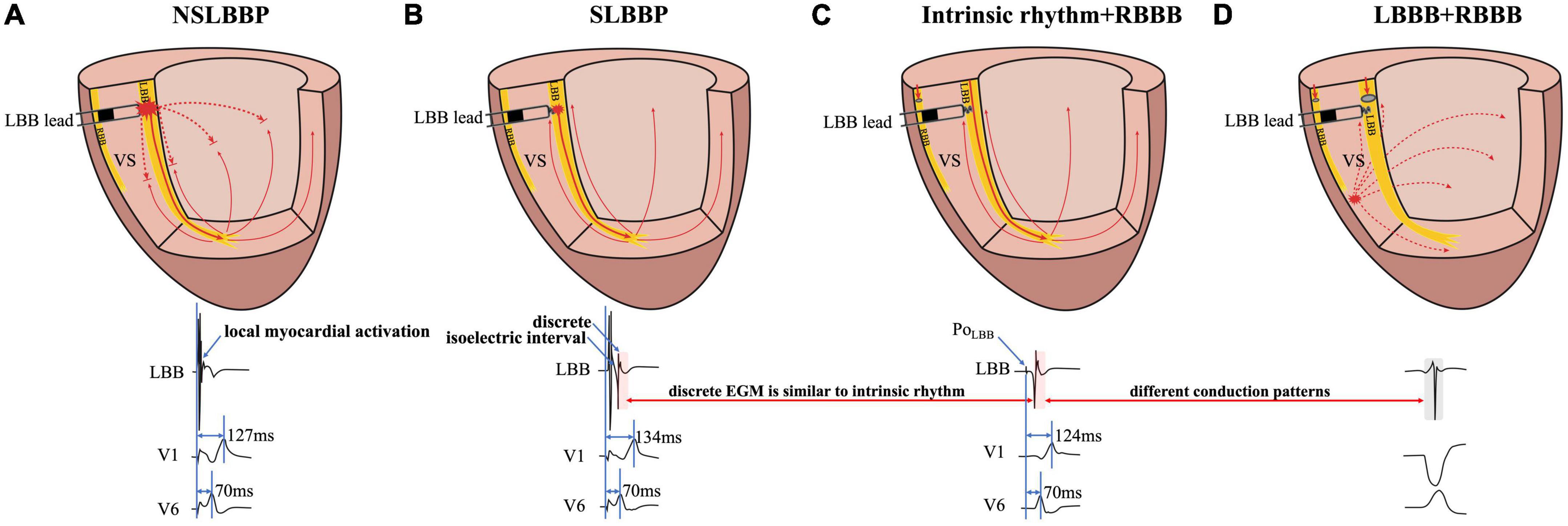 High-pass filter settings and the role and mechanism of discrete ventricular electrograms in left bundle branch pacing